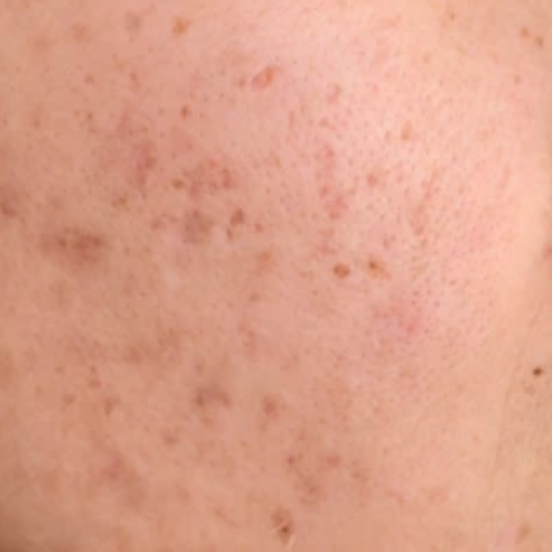 炎症後色素沈着(くすみ)